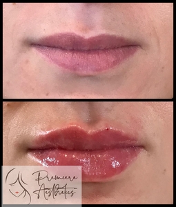 Restylane Kysse Lips-before