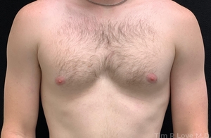 Patient is 2 months Post Bodytite of the chest. Patient is 6'1 and 180 Lbs-before
