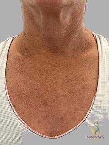 One week post Nouvaderm MOD-before