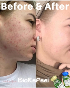 BioRepeel-before