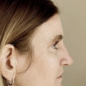 Brow & Eye Lift #1-after