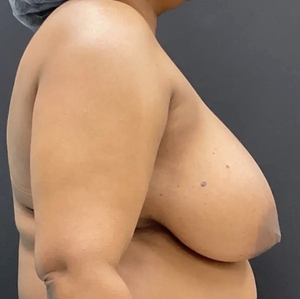 Breast Reduction #6 (right)-before