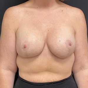 Breast Augmentation #22 350/410 cc-after
