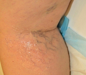 Laser Vein Removal #1-before