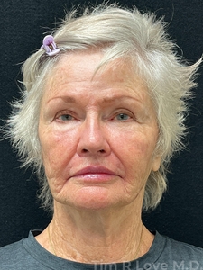Facial Rejuvenation-after