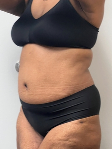Tummy Tuck-after