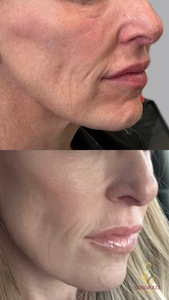 Xerf one treatment-before