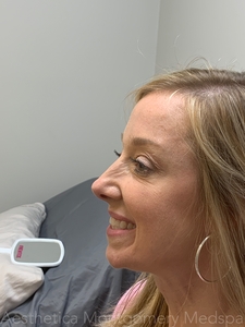 Crows feet Jeuveau-after