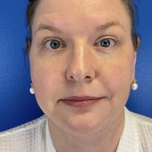 Lipo w Skin Tightening Face #8-after