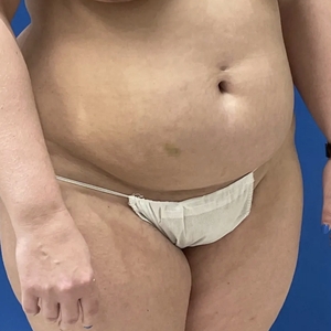 Lipo w Renuvion #2-before