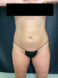 plus lipo 2.0-after