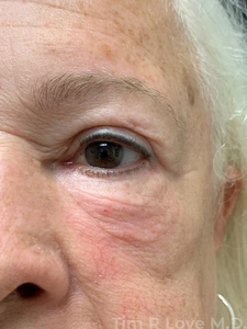 With periorbital Morpheus/Fractora-after