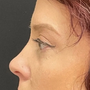 Brow & Eye Lift #4-after