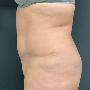 Tummy Tuck #13-after