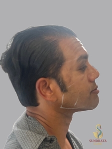 Nouvaderm Micro, PladuoPro and Cellenis Derma PRP one treatment-before