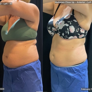 Coolsculpting-before