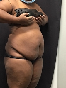 Lipo 360 + mini tummy tuck-before