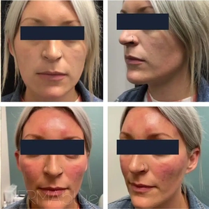 Botox / Juvederm Voluma-before