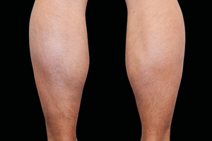 4 Treatments-after