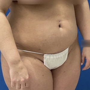 Lipo w Renuvion #2-after