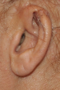 Ear Reconstruction-after
