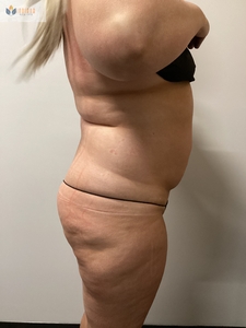 After 1 instasculpt treatment-after