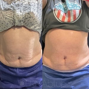 CoolSculpting 6-Cycles-before