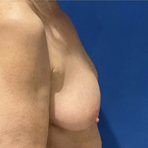 Breast Augmentation #8 590 cc-before