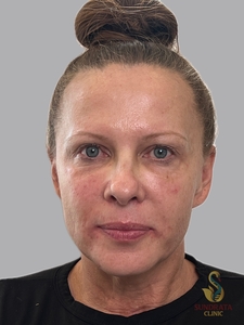 Cellenis Derma 11 ML kit, tear troughs and Cheeks-before