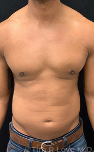 2 months post op-after