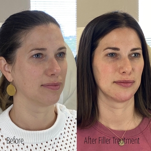 Filler B/A SBA 15-before