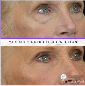 Midface/Undereyes-before