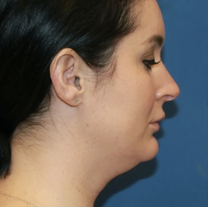 Lipo w Renuvion Face #1 (right)-before
