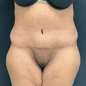 Tummy Tuck #16-after