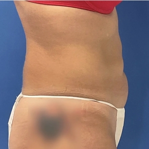 Tummy Tuck #15-before