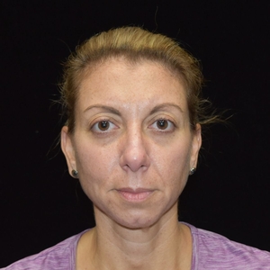 Midface, chin, marionette lines, nasolabial folds-before