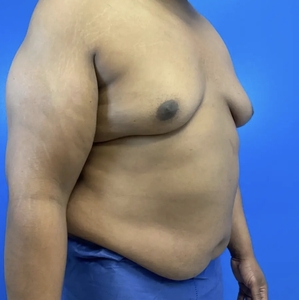 Lipo w Renuvion #9-before