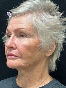 Facial Rejuvenation-after