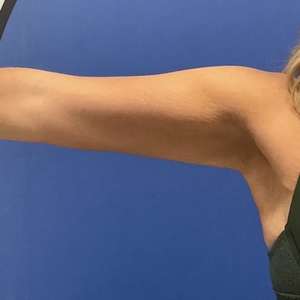 Lipo w Renuvion #11-after