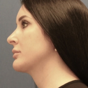 Lipo w Renuvion Face #1 (left)-after