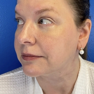 Lipo w Skin Tightening Face #8-after