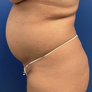 Lipo w Renuvion #3-before