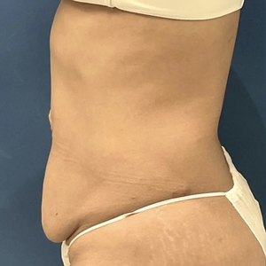 Tummy Tuck #2-before