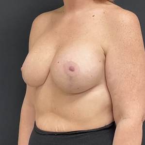 Breast Augmentation #22 350/410 cc-after