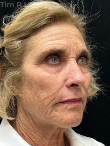 1 year post op face and neck lift, Morpheus8, Fraxel, Nanofat, Sculptra, Lip filler-before