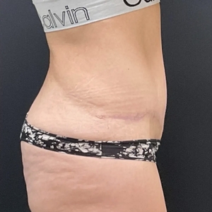 Mommy Makeover #13-after