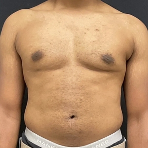 Lipo w BodyTite #9-after