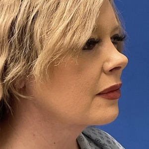 Lipo w Renuvion Face #2 (right oblique)-after