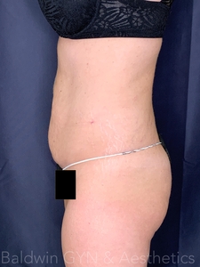 6 weeks abd/flanks/back-after