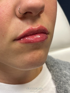 Danielle Glass, RN. - Versa-after